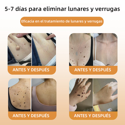 WREE™ Crema para la eliminación de verrugas y etiquetas con veneno de abeja (👨‍⚕Apta para todo tipo de piel)🐝 (🔥Último día de promoción 60% de descuento)🌷