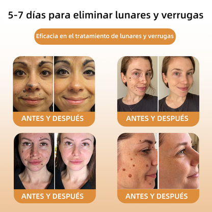 💎WREE™ Crema para la eliminación de verrugas y etiquetas con veneno de abeja (👨‍⚕Apta para todo tipo de piel)🐝 (🔥Último día de promoción 60% de descuento)