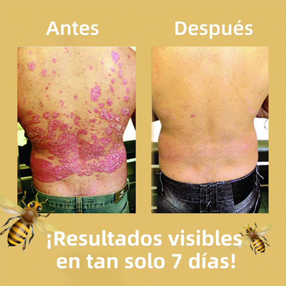 🌈Cvreoz Crema para el Tratamiento de la Piel con Veneno de Abeja (👨‍⚕ RECOMENDADA POR AMD)🐝🐝