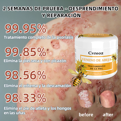 🌈Cvreoz Crema para el Tratamiento de la Piel con Veneno de Abeja (👨‍⚕ RECOMENDADA POR AMD)🐝🐝