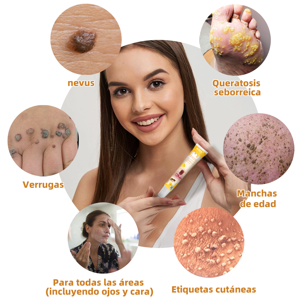 WREE™ Crema para la eliminación de verrugas y etiquetas con veneno de abeja (👨‍⚕Apta para todo tipo de piel)🐝 (🔥Último día de promoción 60% de descuento)🌷